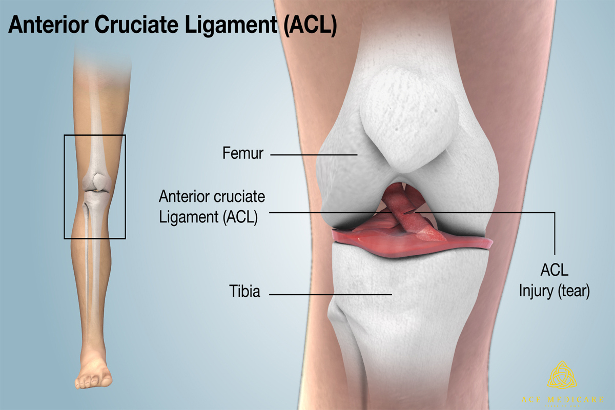 Understanding the Recovery Process After ACL Reconstruction Surgery